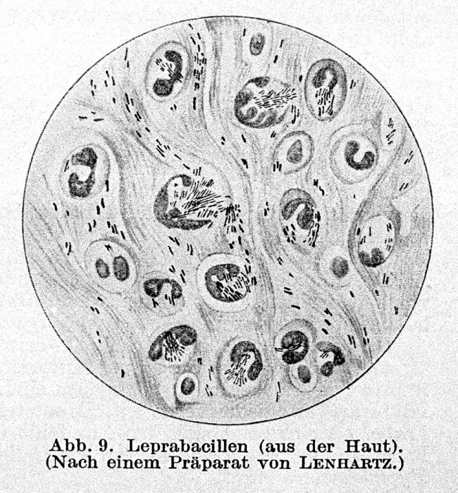 G. H. A. Hansena 1873. gadā atklātā Mycobacterium leprae