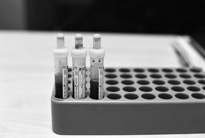 Asiņu paraugi HIV testam